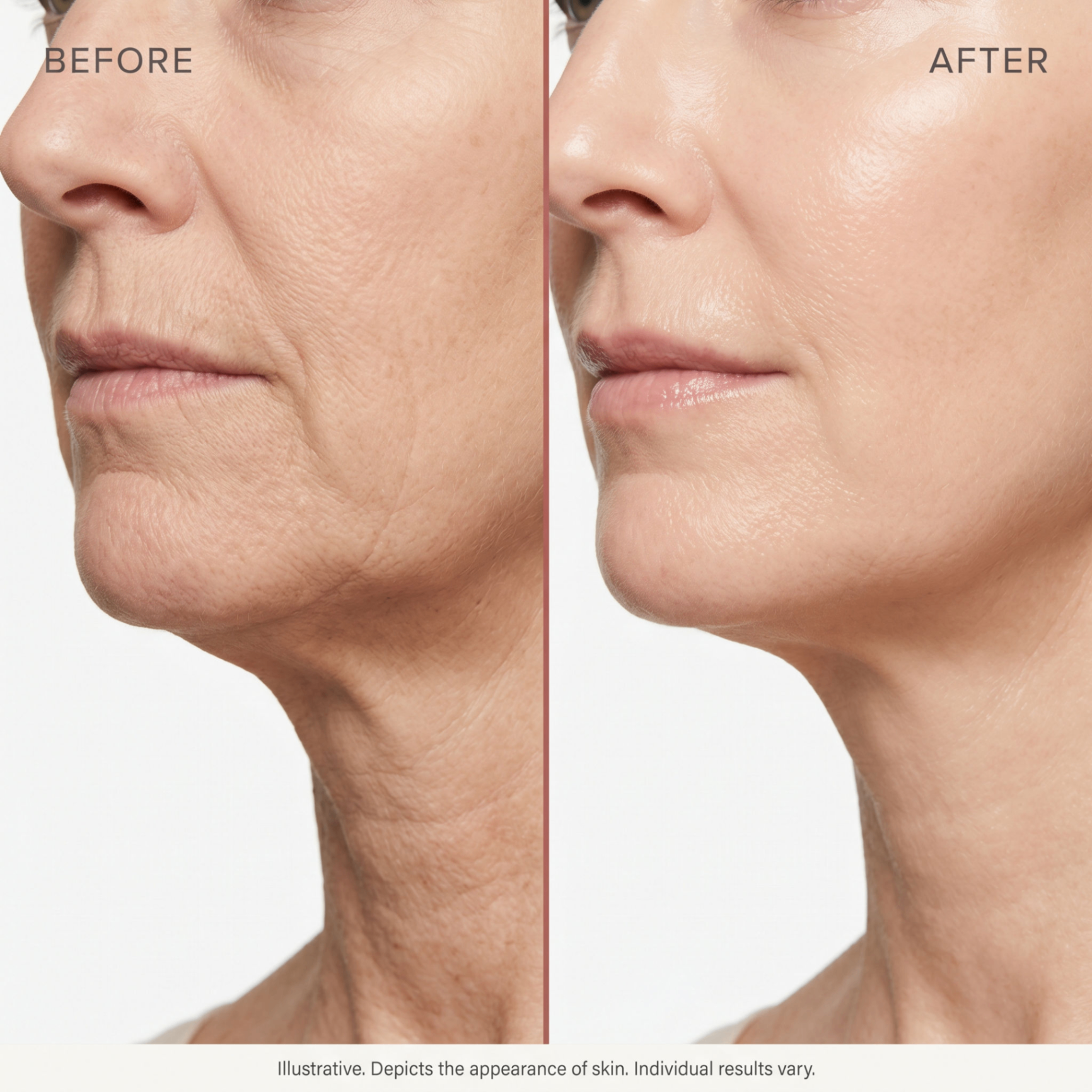 Before and after: firmer, smoother lower face and jawline